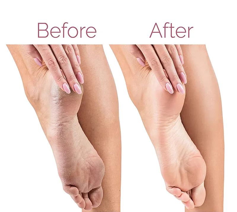 Electric Foot File & Callus Remover | USB Rechargeable Pedicure Tool for Smooth Heels | ALL BAZAR